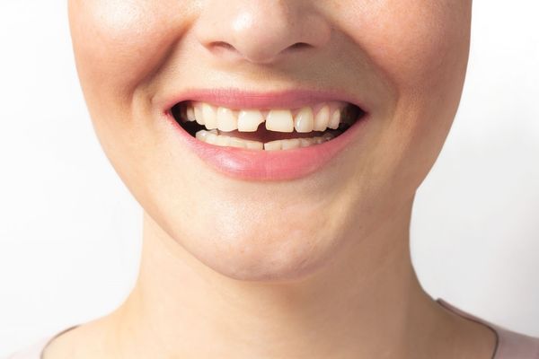 Broken Teeth Image